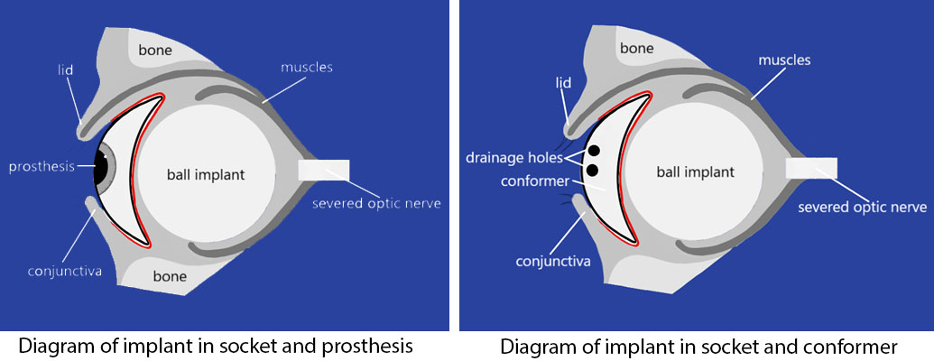 Implant diagrams