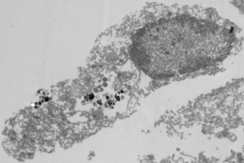 Disruption of the tumor cell due to treatment with nanoparticles and visible light.